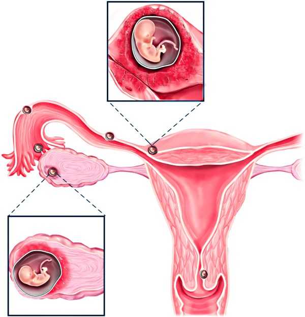 Внематочная беременность — большая медицинская энциклопедия
