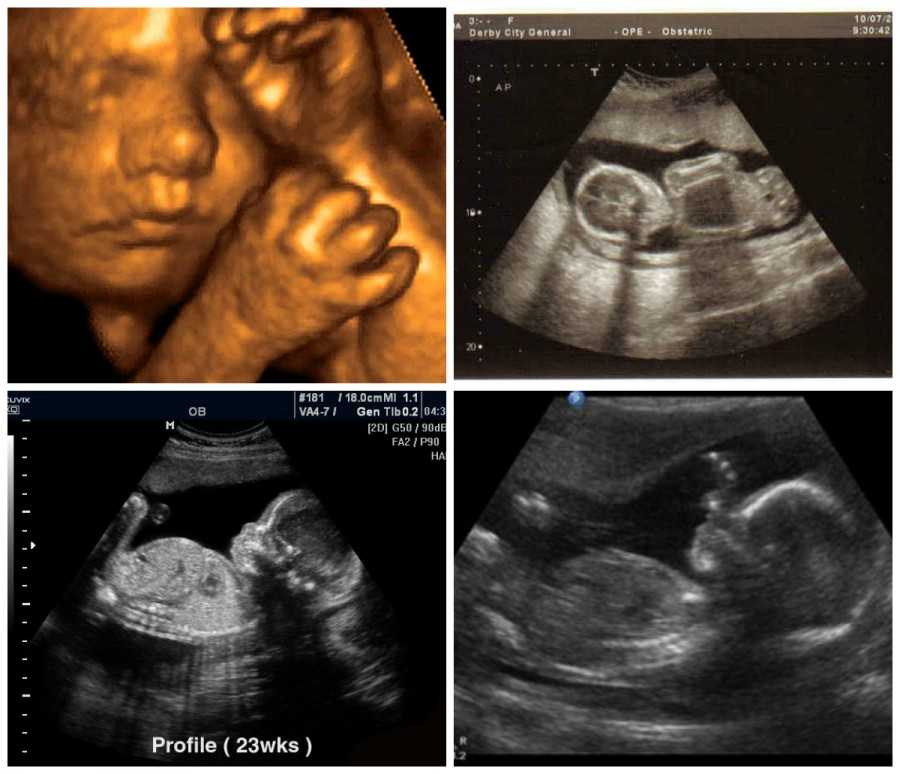 живот на 23 неделе беременности фото, 23 неделя беременности фото животиков, фото беременных на 23 неделе беременности