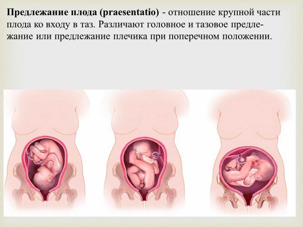 Предлежание плода – что нужно знать будущей маме - наблюдение беременности.  здоровье