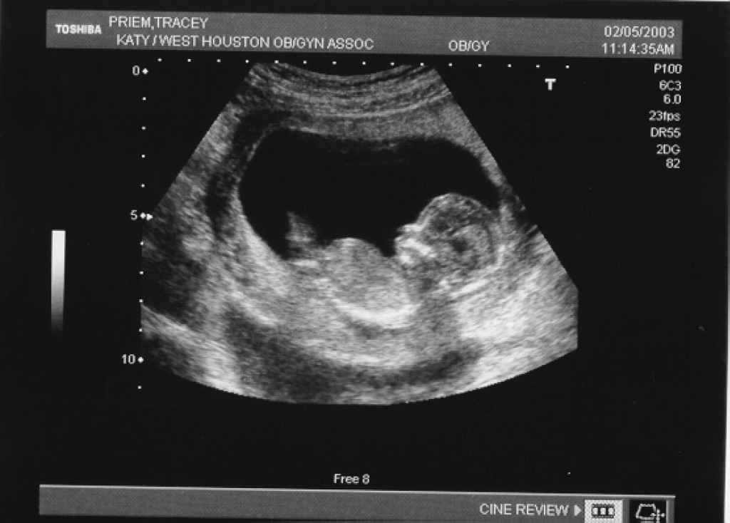  18 неделя беременности - ощущения и фото 