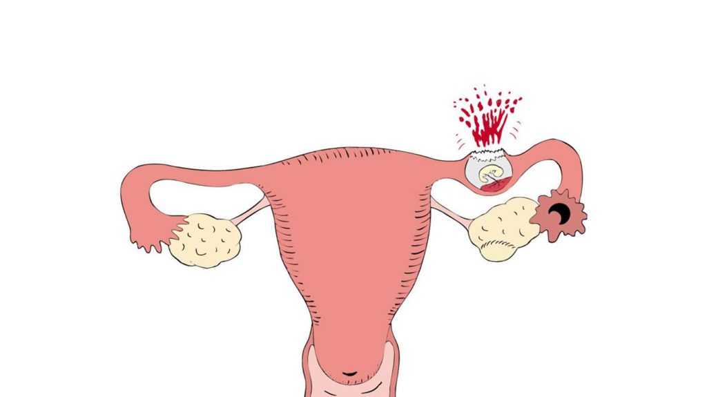Внематочная беременность | «за рождение» киров