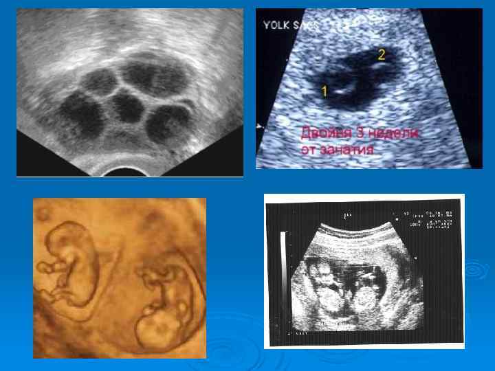Роды двойни: естественные или кесарево сечение | как проходят роды двойни