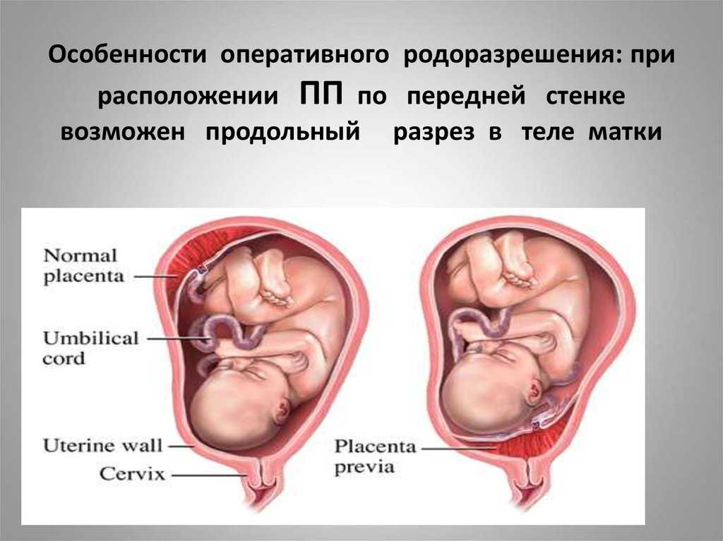 Плацента по передней стенке матки - признаки и возможные варианты локализации, шевеление плода, роды