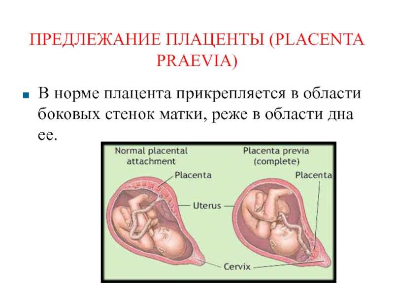 Родоразрешение беременных с врастанием плаценты без рубца на матке » библиотека врача
