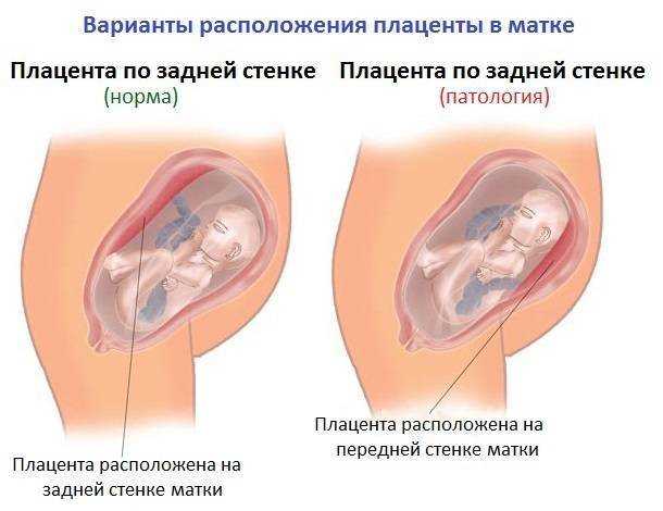 Плацента по передней стенке – что это значит, как еще может быть расположен орган в матке? | konstruktor-diety.ru