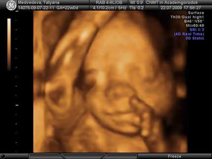 18 неделя беременности - ощущения и фото — евромедклиник