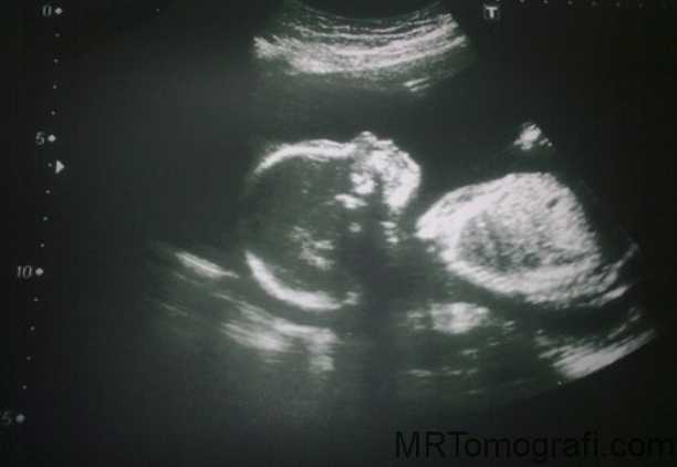 20 неделя беременности шевеления и фото  плода — евромедклиник