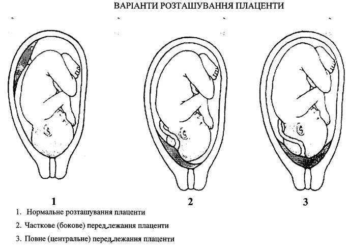 Расположение плаценты по передней стенке: особенности течения беременности и возможные риски