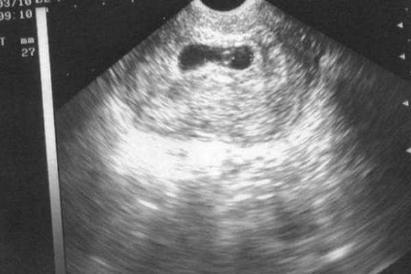 Пиелонефрит при беременности (болят почки) — симптомы, лечение, профилактика | «восьмая клиника»