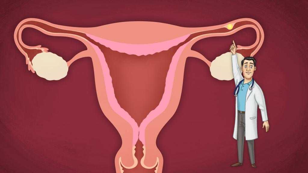 Причины и ранняя диагностика внематочной беременности