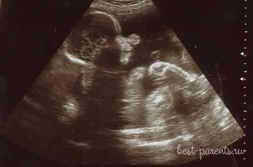 Формы живота при беременности девочкой и мальчиком (фото)