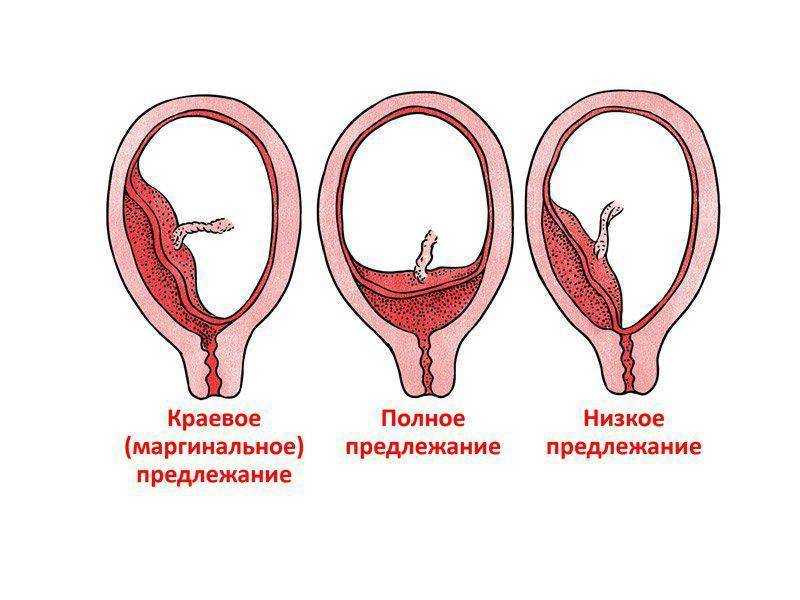 Плацента по передней стенке матки и ее предлежание
