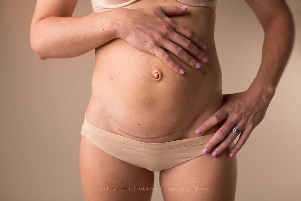 Как убрать живот после родов