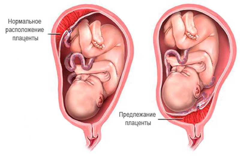 Беременность и вич: можно ли родить здорового ребенка с диагнозом вич?