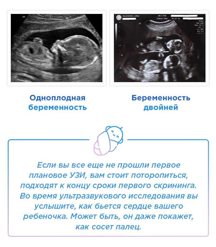 Чудо в животике: многоплодная беременность.