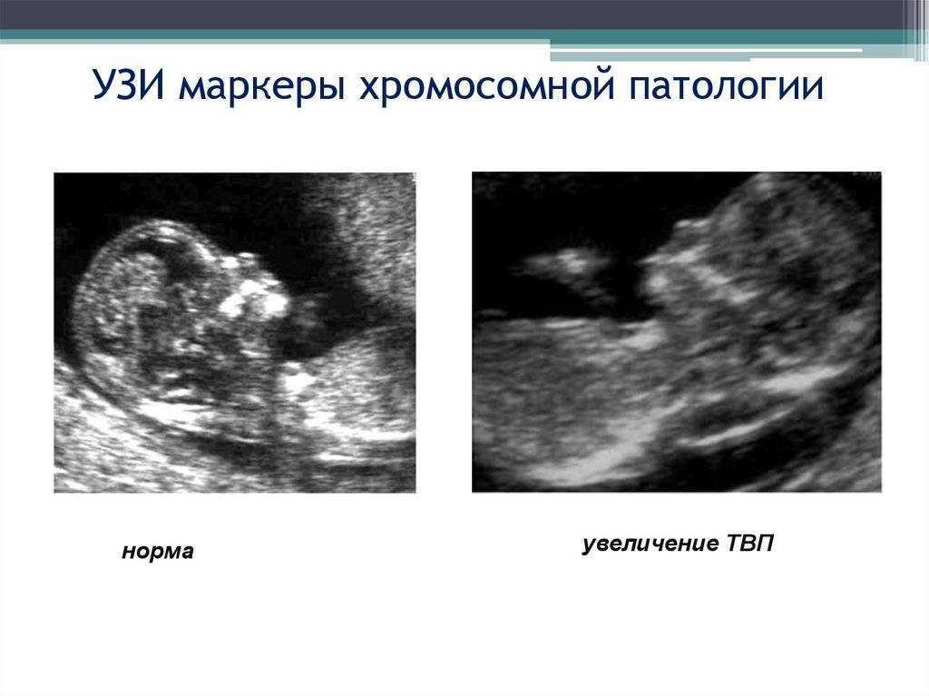 Коронавирус и беременность. исследования о планировании беременности и ковиде за 2020-2021. интервью с врачом-гинекологом-репродуктологом