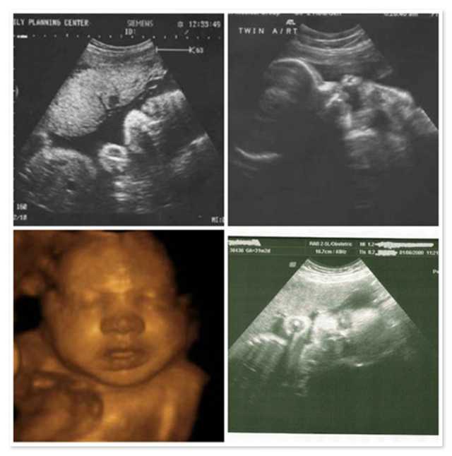 живот на 32 неделе беременности фото, 32 неделя беременности фото животиков, фото беременных на 32 неделе беременности, Окружность живота на 32 неделе беременности