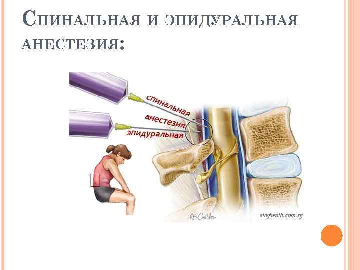 Эпидуральная анестезия препараты