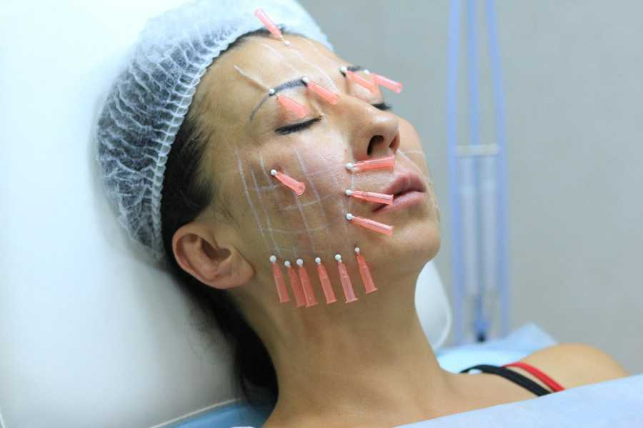 Подтяжка уголков рта – как убрать хмурое выражение и «линии марионеток» - клиника косметологии