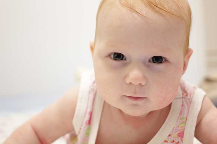 Пищевая аллергия у ребёнка: что делать родителям?