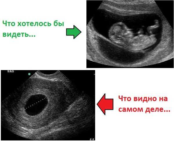 Днк-фрагментация сперматозоидов как причина невынашивания беременности