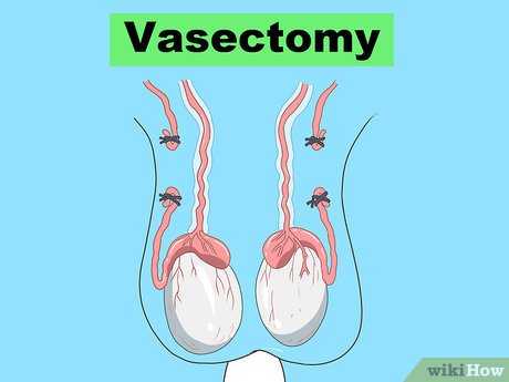 Вазэктомия – мужская стерилизация