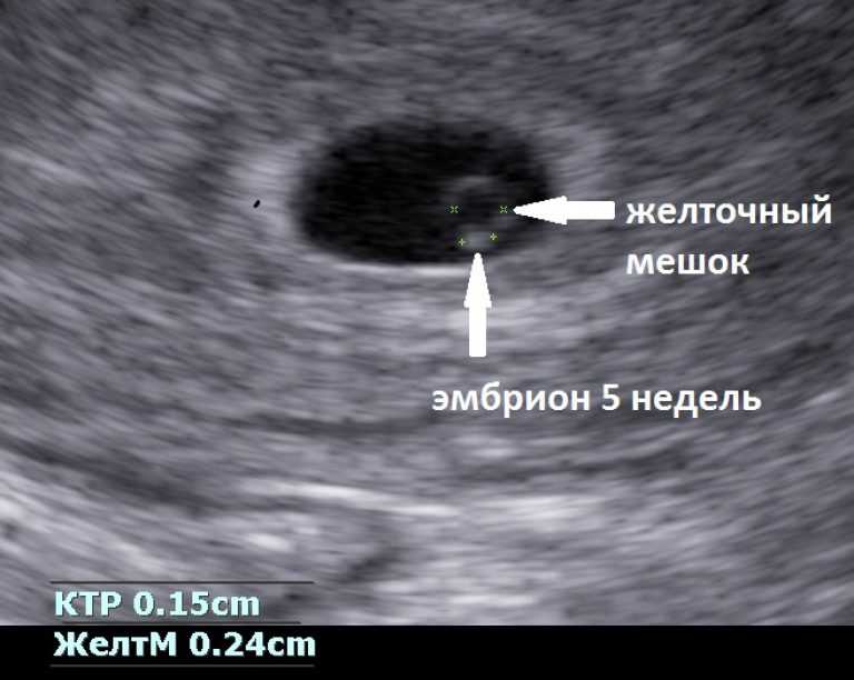 Анэмбриония или почему не видно эмбриона на узи