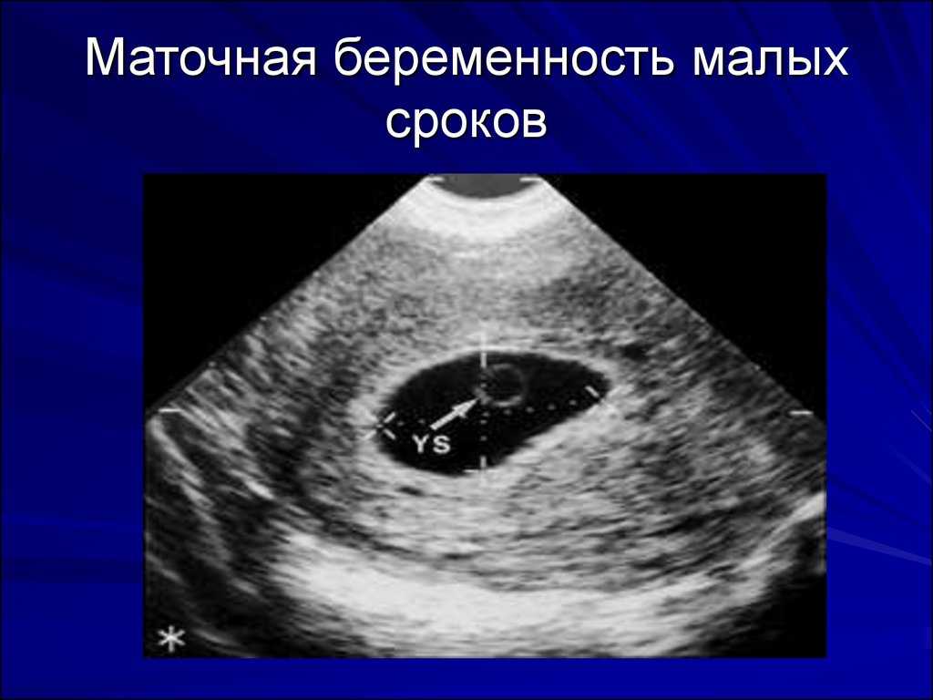 Тиреотоксикоз и беременность