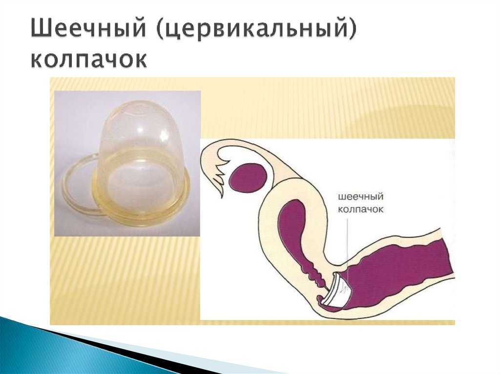 Контрацепция - когда она необходима и как правильно выбрать метод