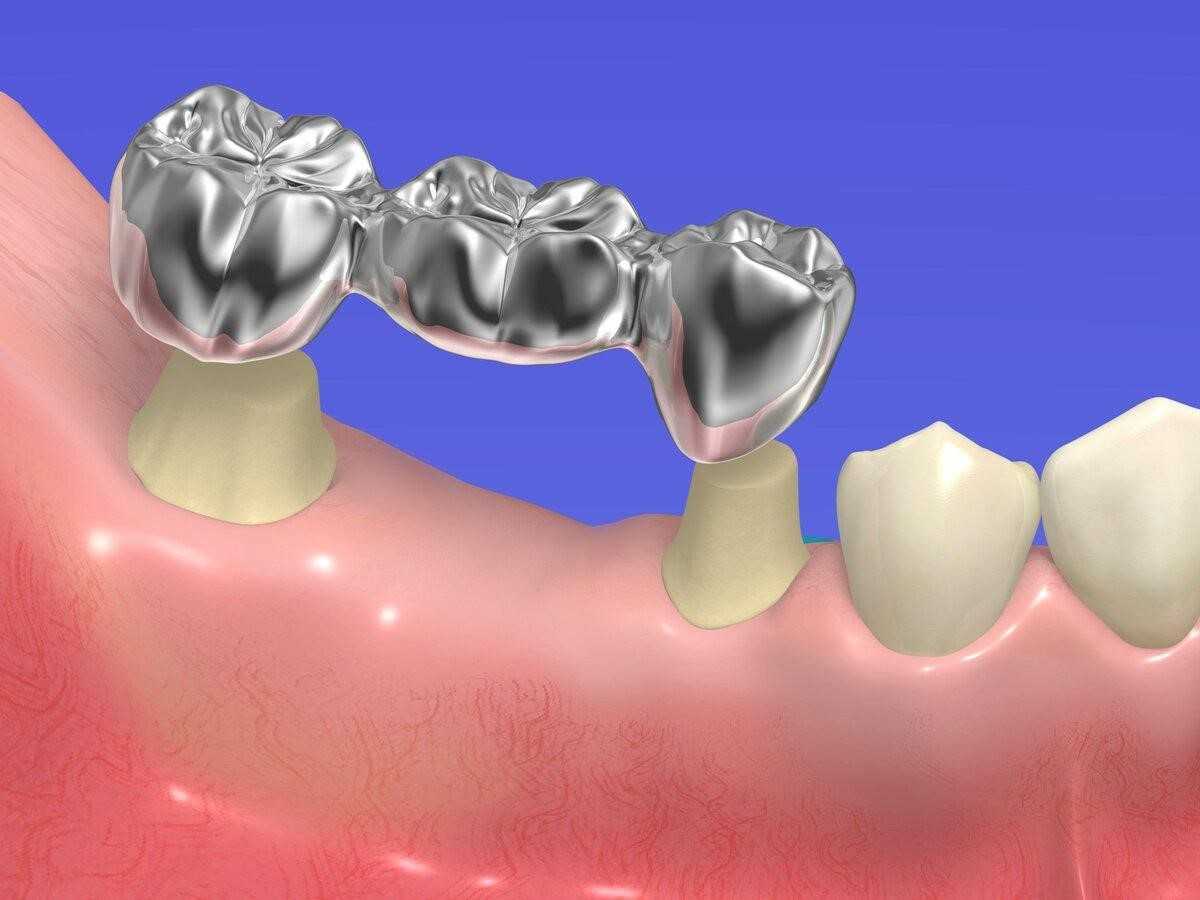 мосты и коронки что это