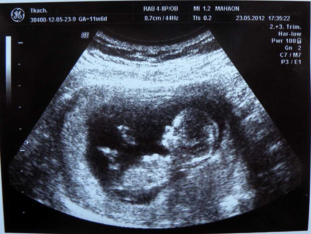 11 неделя беременности: что происходит в 3 месяц от зачатия?