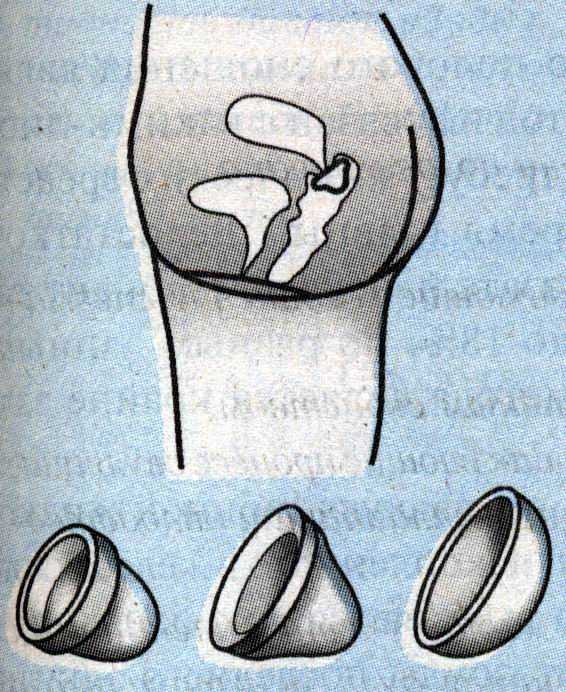 Цервикальный метод контрацепции