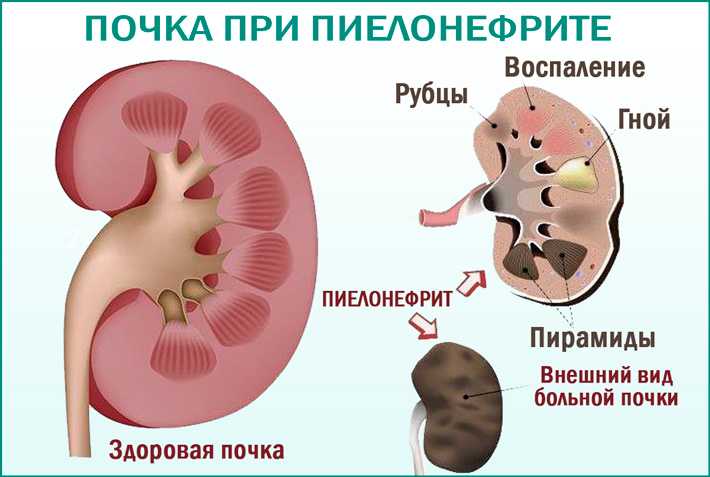 Гломерулонефрит и беременность. симптомы. диагностика. лечени гломерулонефрита.