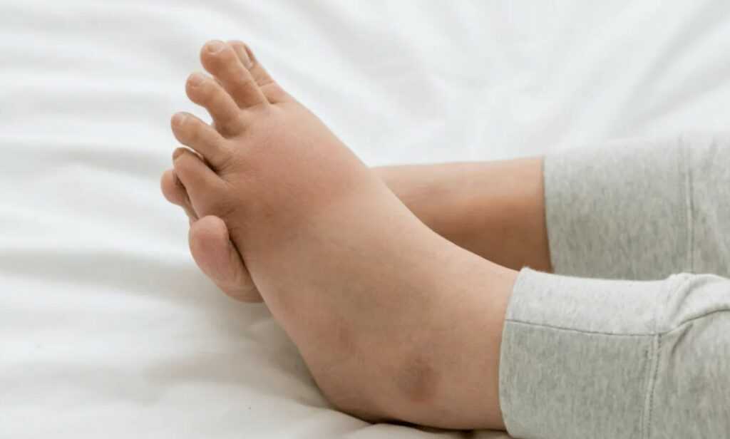 Онемение ног и рук - лечение, симптомы, причины, диагностика | центр дикуля