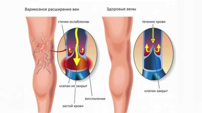 Ретикулярный варикоз нижних конечностей: признаки, причины и лечение ретикулярного расширения вен