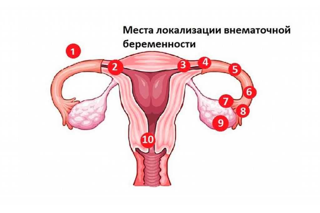 Внематочная беременность, признаки и симптомы внематочной беременности на раннем сроке, фото