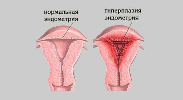 Две менструации за один месяц - повод для беспокойства? * клиника диана в санкт-петербурге