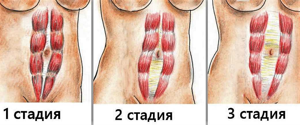 Диастаз прямых мышц живота после родов | форум prof-medicina.ru