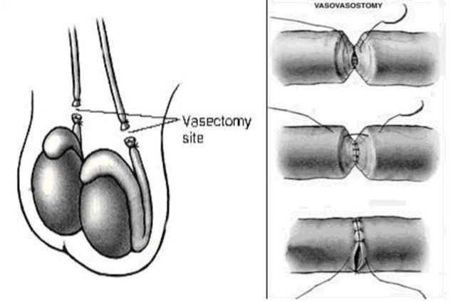 Вазэктомия - vasectomy