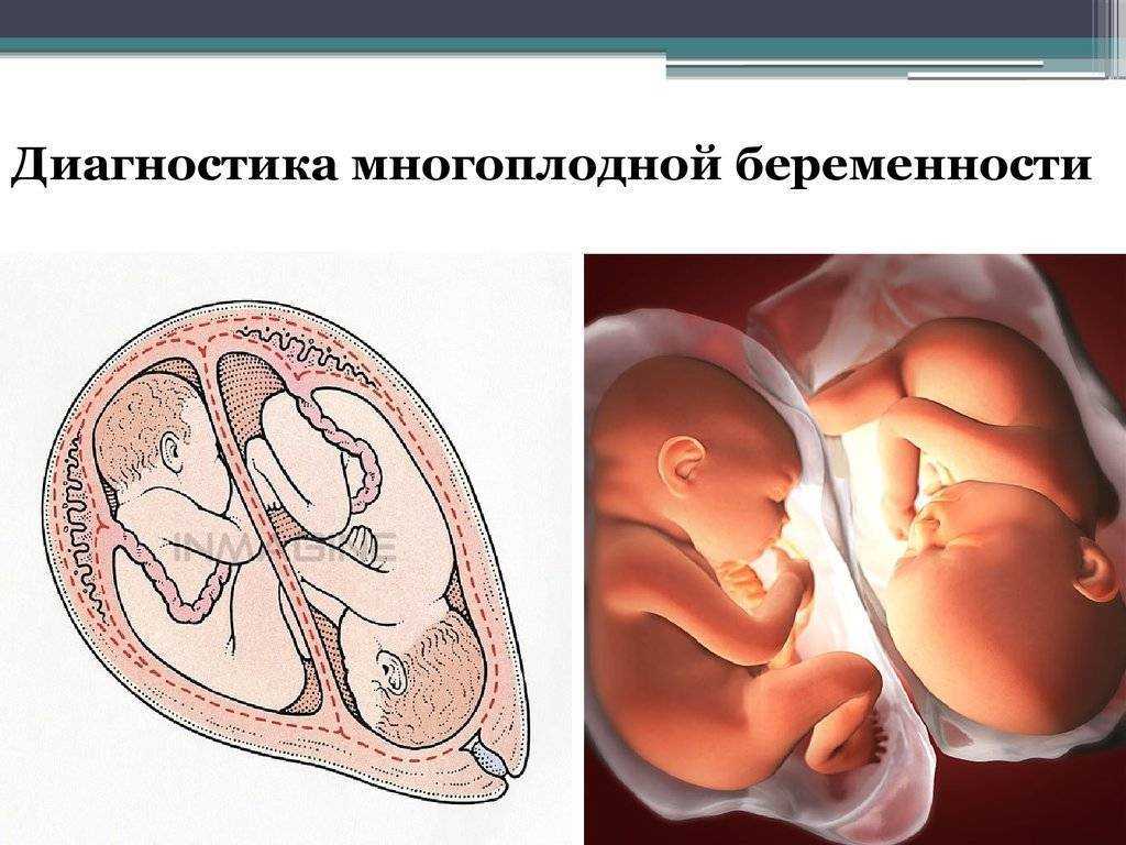 Многоплодная беременность: каковы риски и как их избежать? * клиника диана в санкт-петербурге